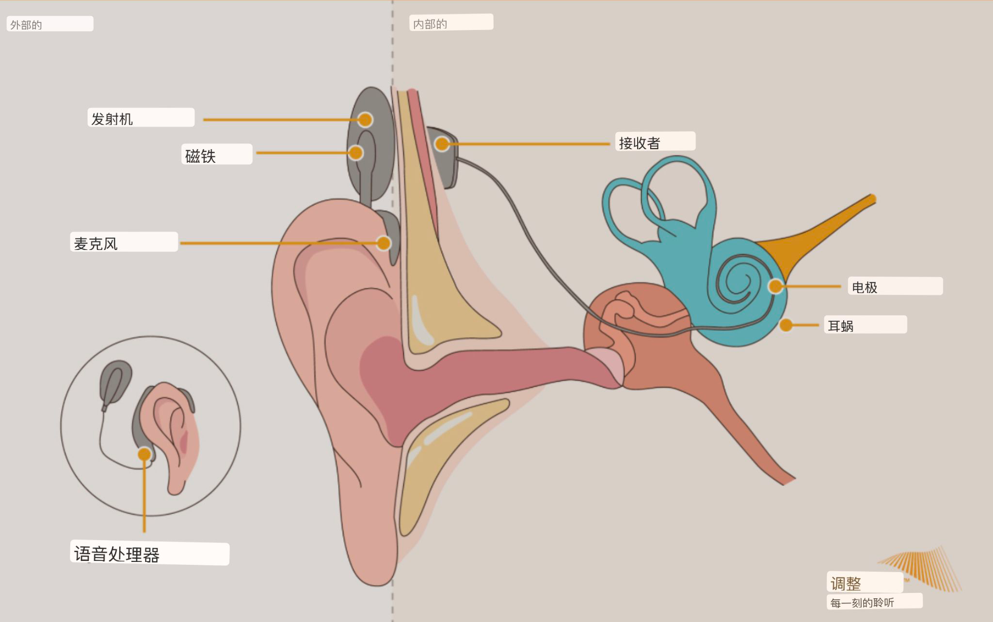 人工耳蜗示意图图片
