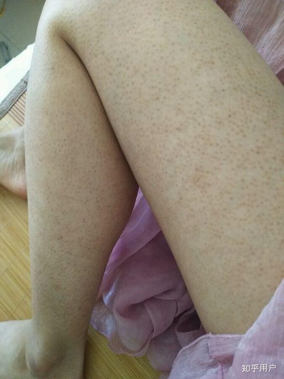 腿上鸡皮肤怎么去