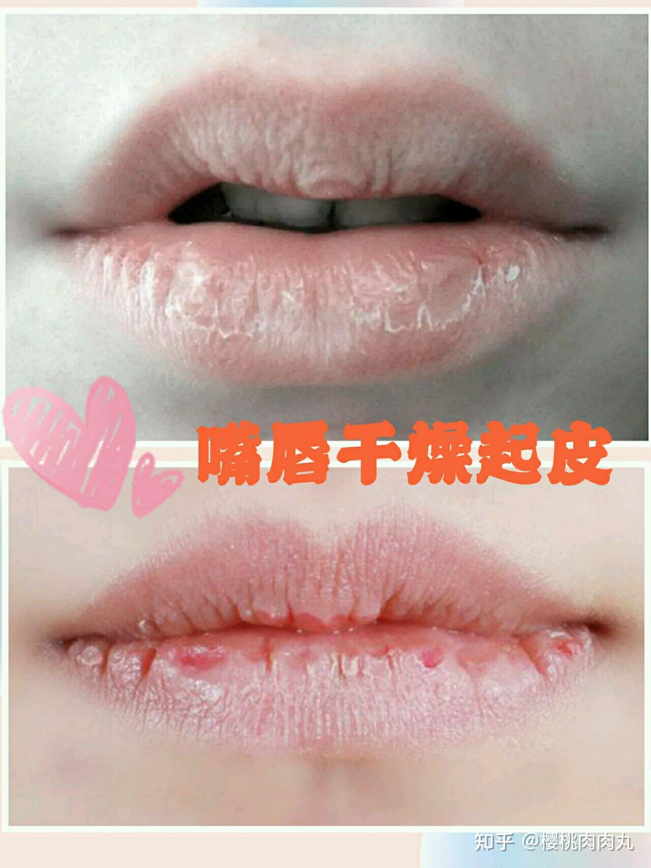 【体験談】唇に水泡ができる人は口紅アレルギーを疑うべき！症状から改善法までまとめ | COCOSUKE BOWL