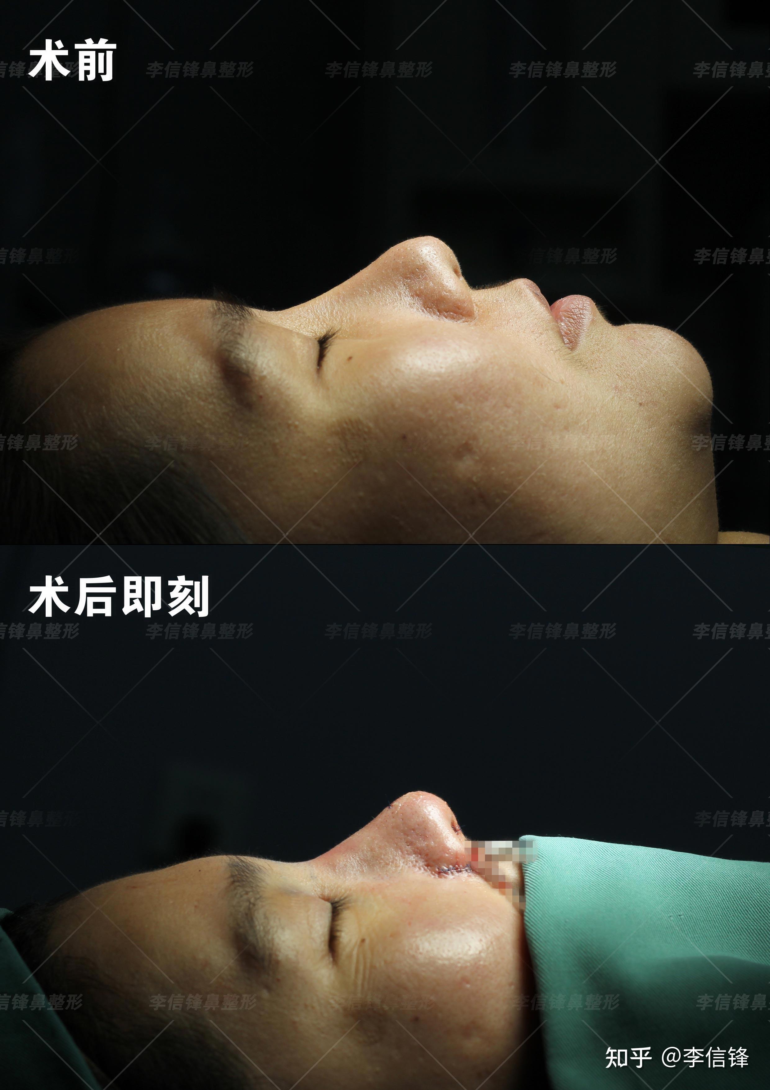 棍感、鼻头塌,鼻翼外扩鼻修复案例,术后即刻—深圳李信锋隆鼻综合整形 - 知乎
