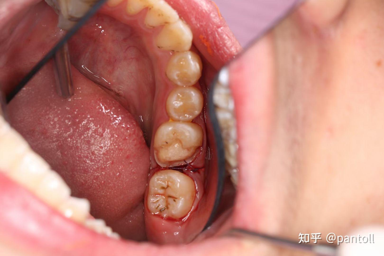 牙齿空了黑了怎么办? - 知乎