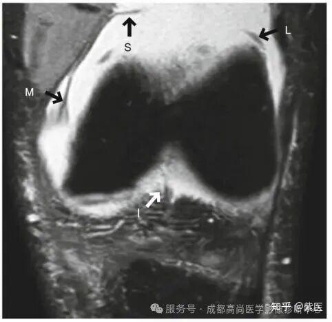 膝关节滑膜皱襞综合征(MPS)MR诊断 - 知乎