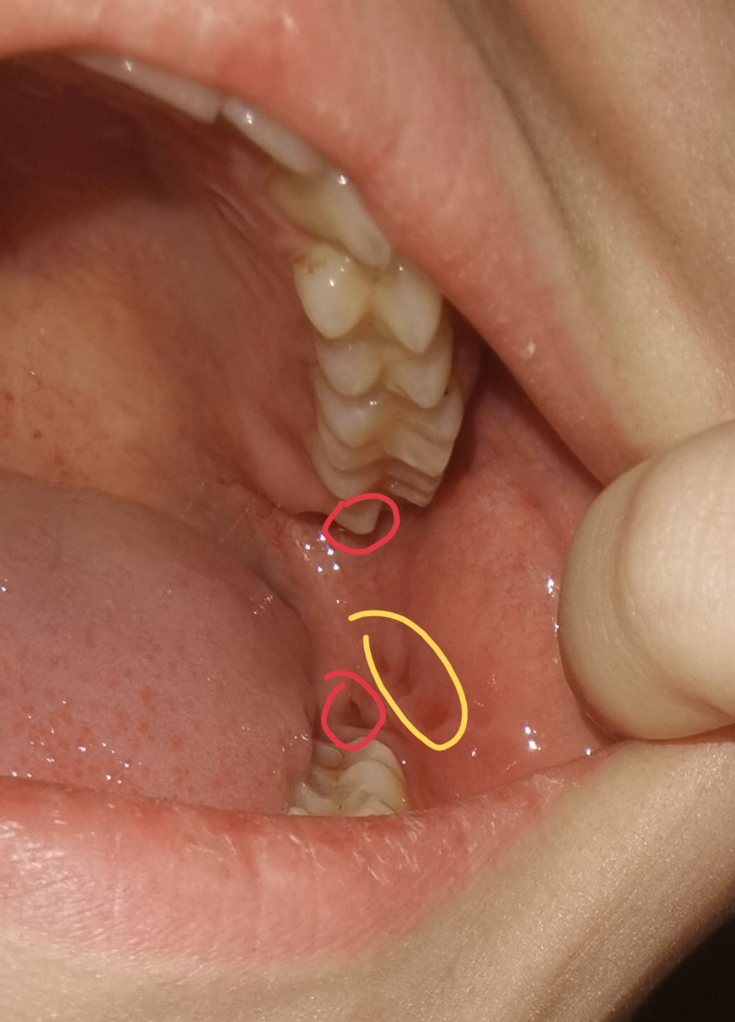 拔智齿有多痛?