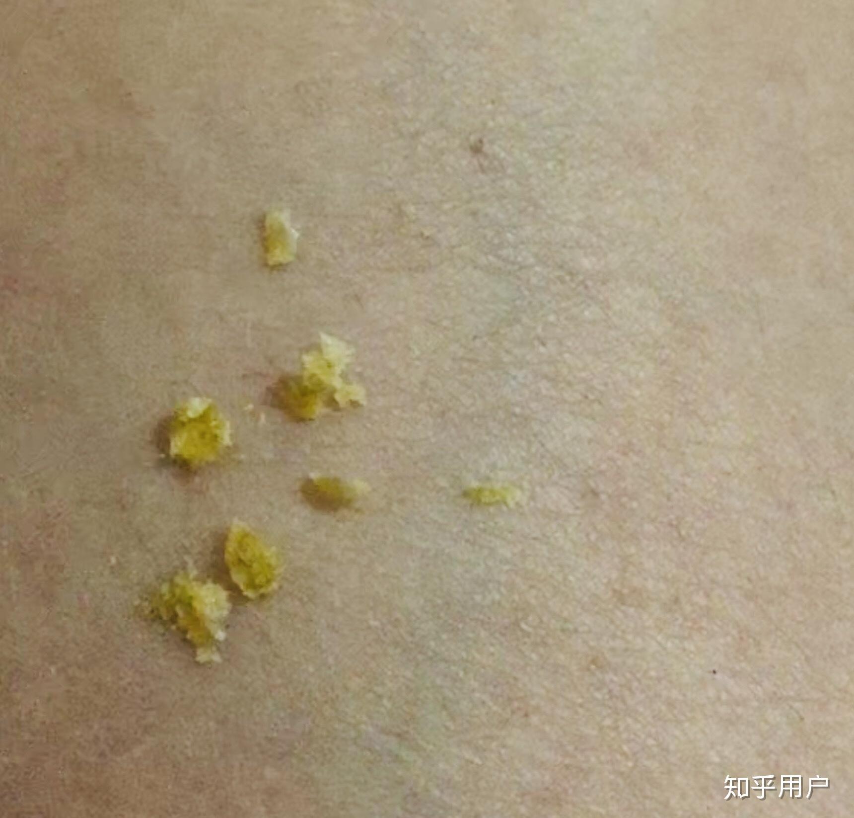 经常掏耳屎的人耳朵里还会有那种超大的耳屎就像一些视频里拍的那样吗