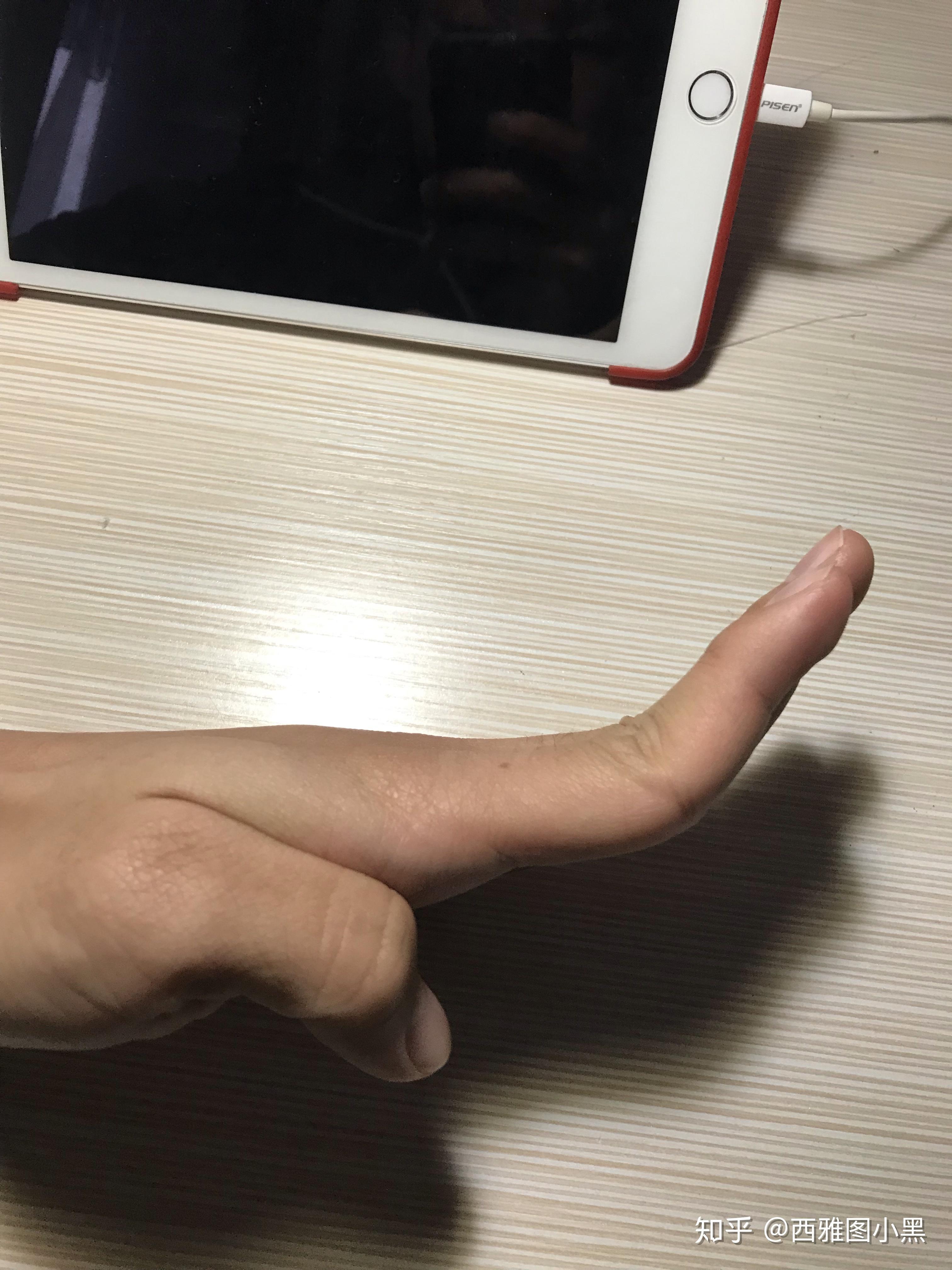 手指伸直后手指的第一个指节向上翘起这是因为什么原因