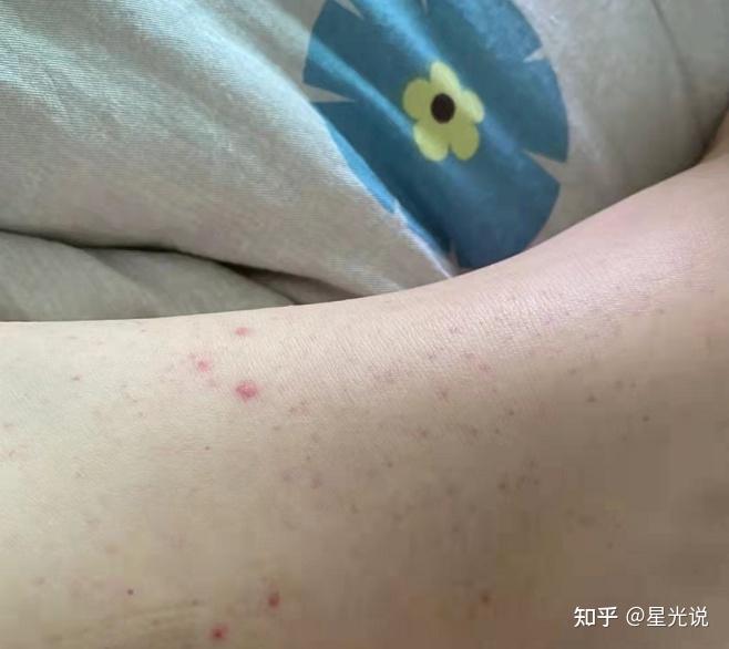 白血病的最初症状是什么