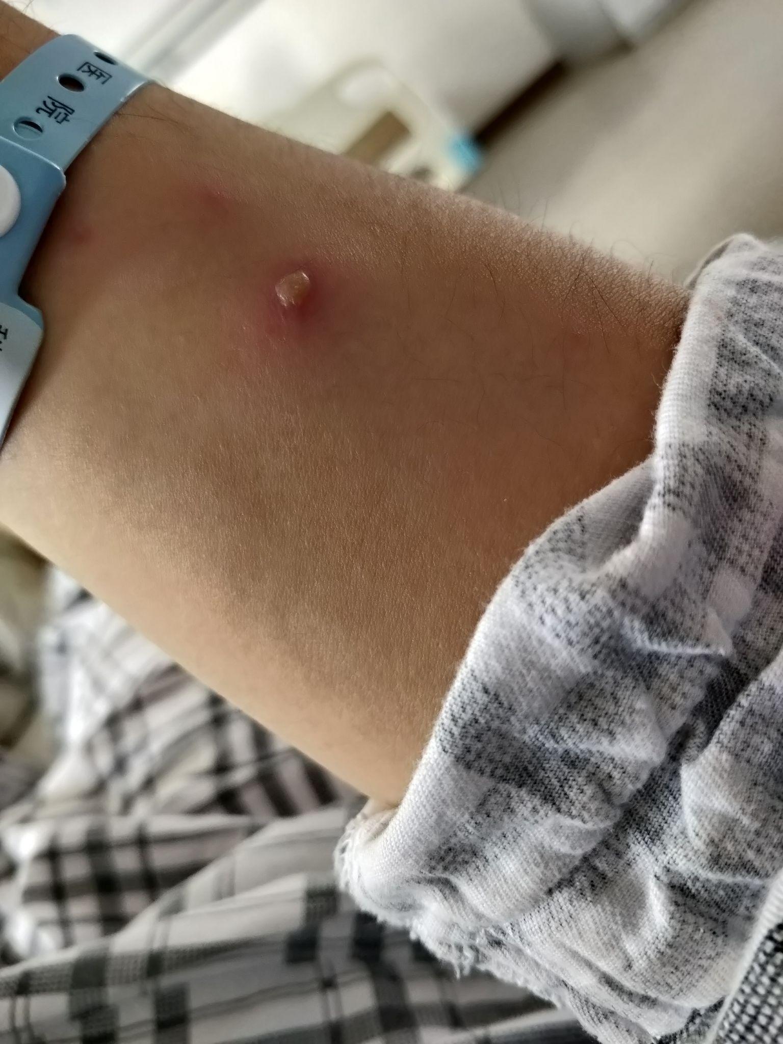 成人长水痘是什么样的经历? - 知乎