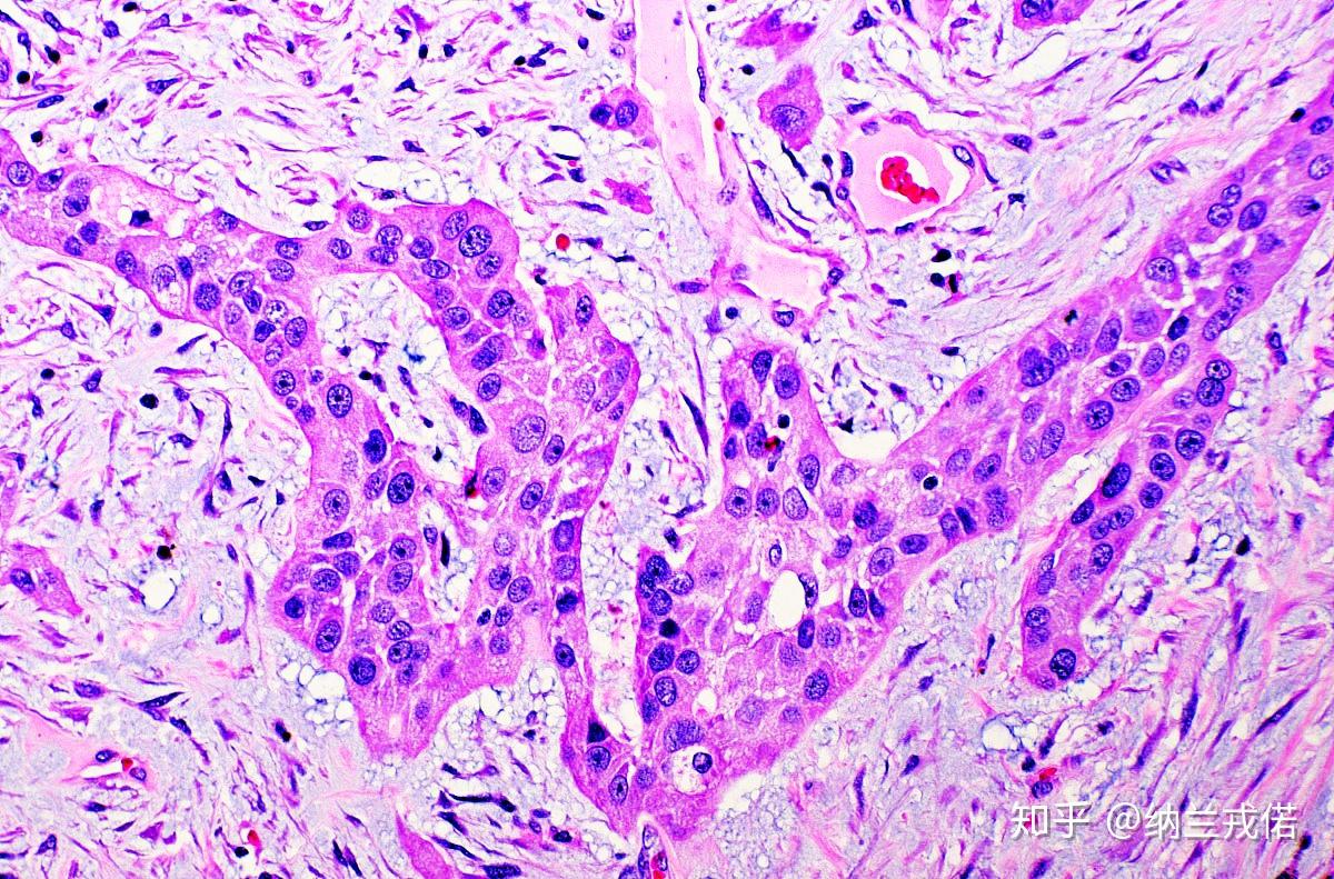 病理学红蓝铅笔图肿瘤异型性怎么画呀跪求