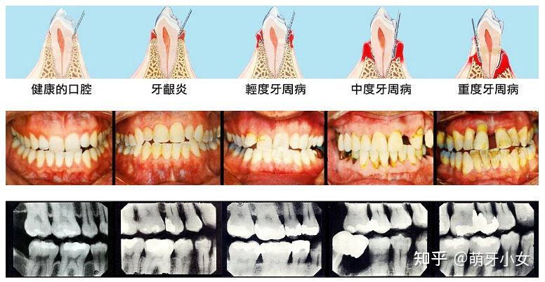 怎样判断牙周炎牙槽骨吸收程度