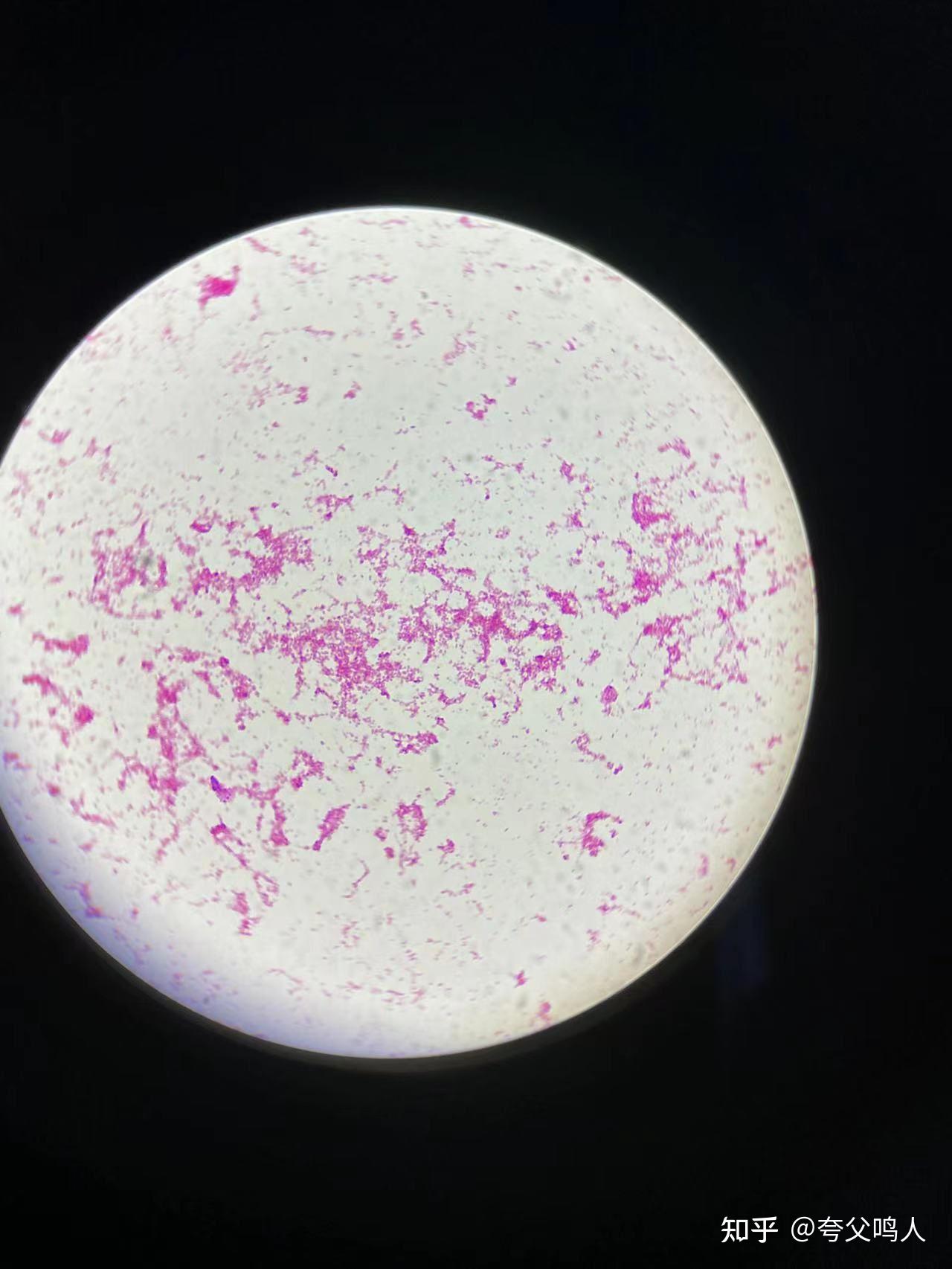 涂片镜检可见短小的球杆菌,形态像似散在的细小沙粒样. 液体