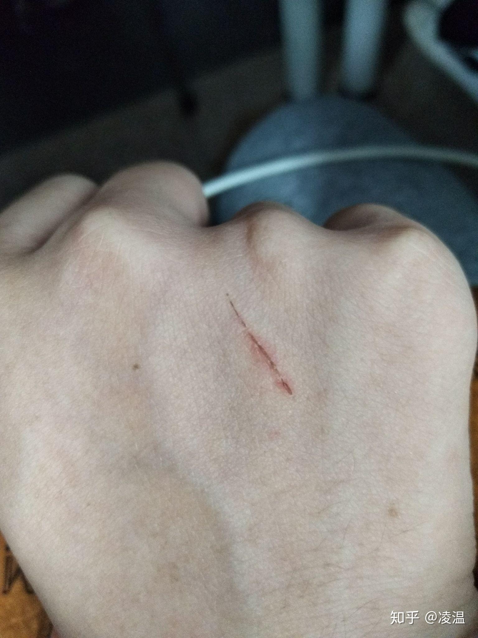 被猫抓破出血了会有事吗?