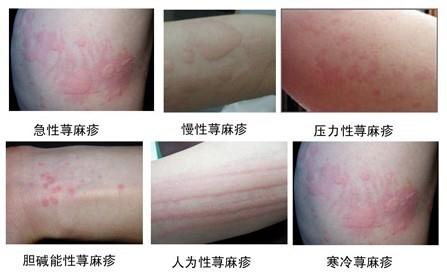 招飞体检之常见异常胆碱能荨麻疹