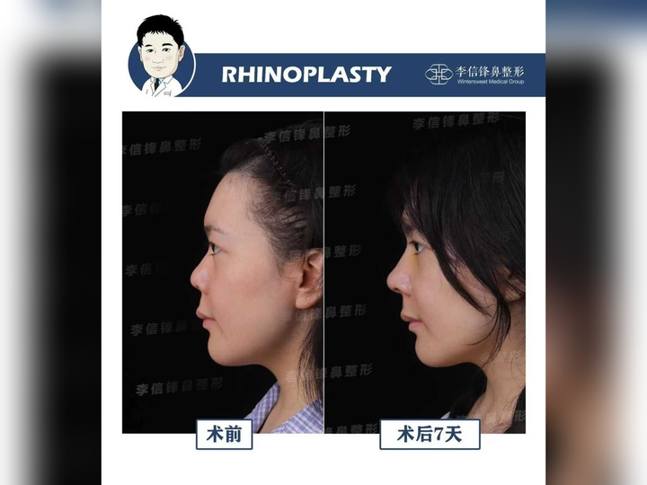初鼻鼻综合-短鼻朝天、漏鼻孔,鼻基底凹陷改善,术后七天对比~ - 知乎