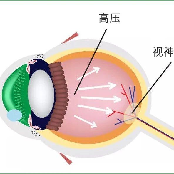 关灯玩手机会得青光眼?看完这篇颠覆你认知 - 知乎