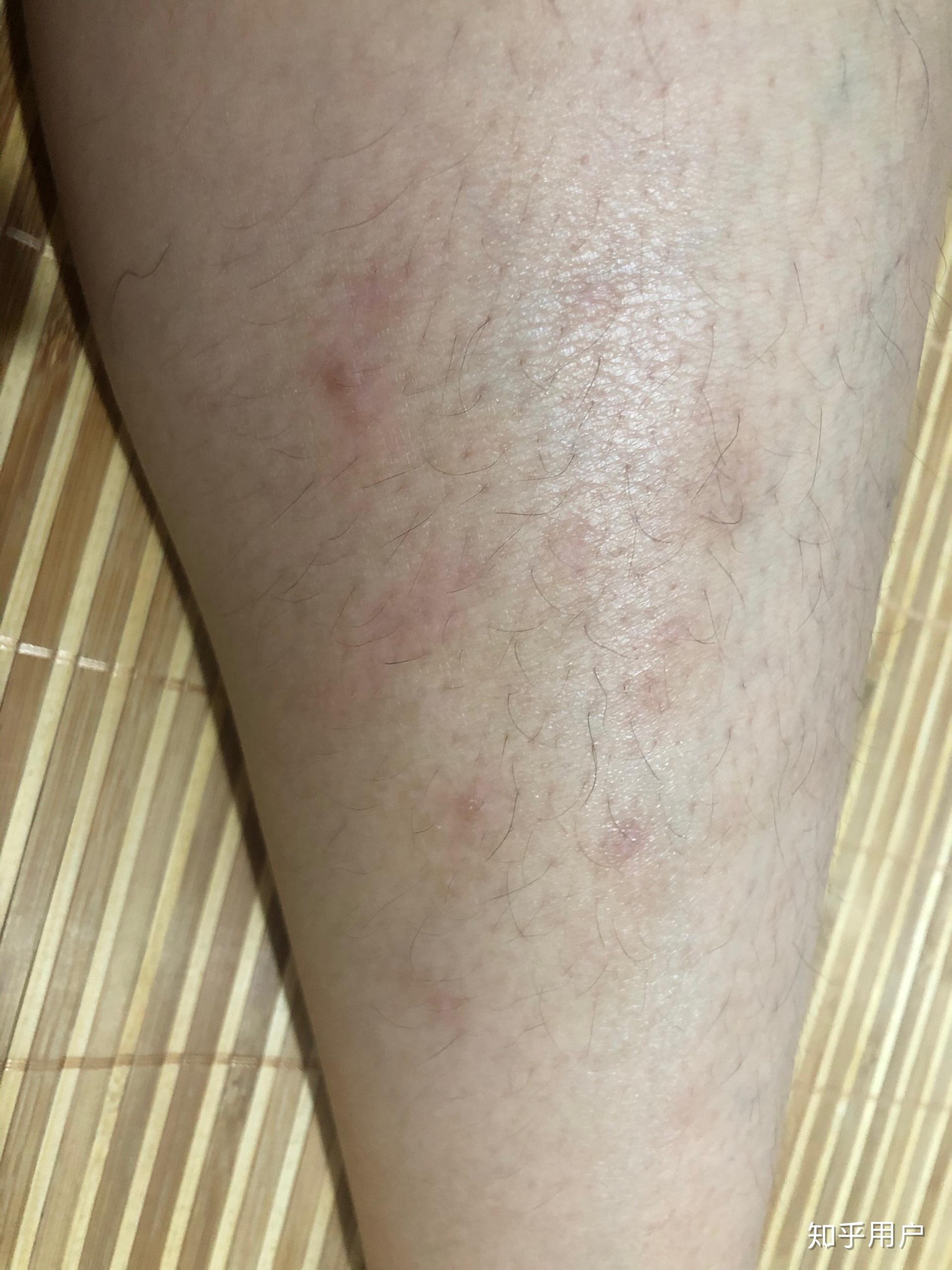 小腿特别痒持续了两个月了一直不好越挠越痒挠破皮结了一腿的疤