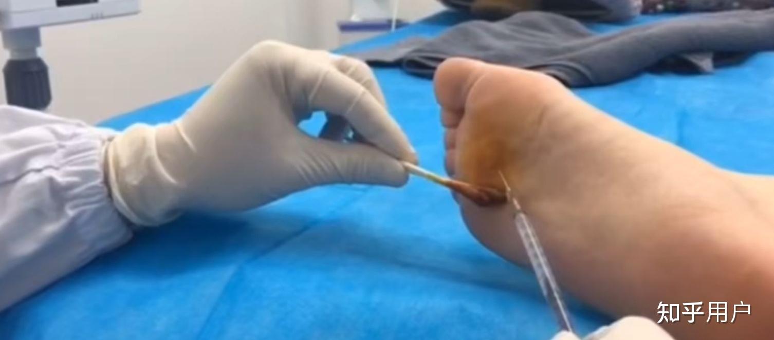 从脚底打针是不是非常疼