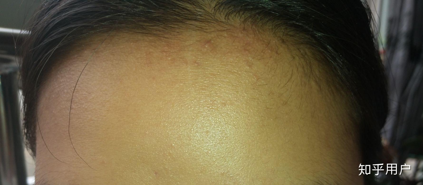 额头发际线长出了这些是痘痘还是皮肤病? - 知乎