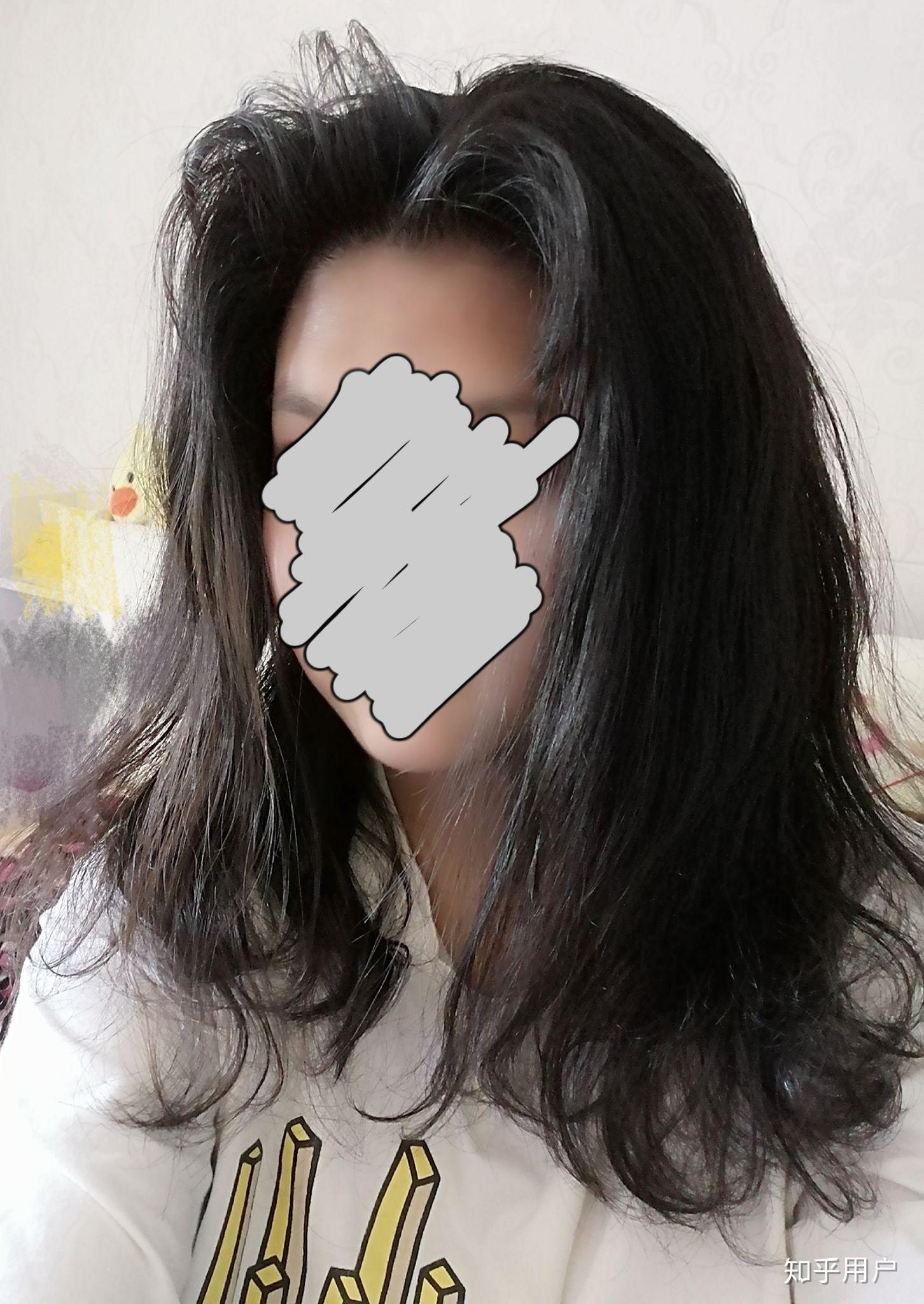 见过的最大头皮屑多大