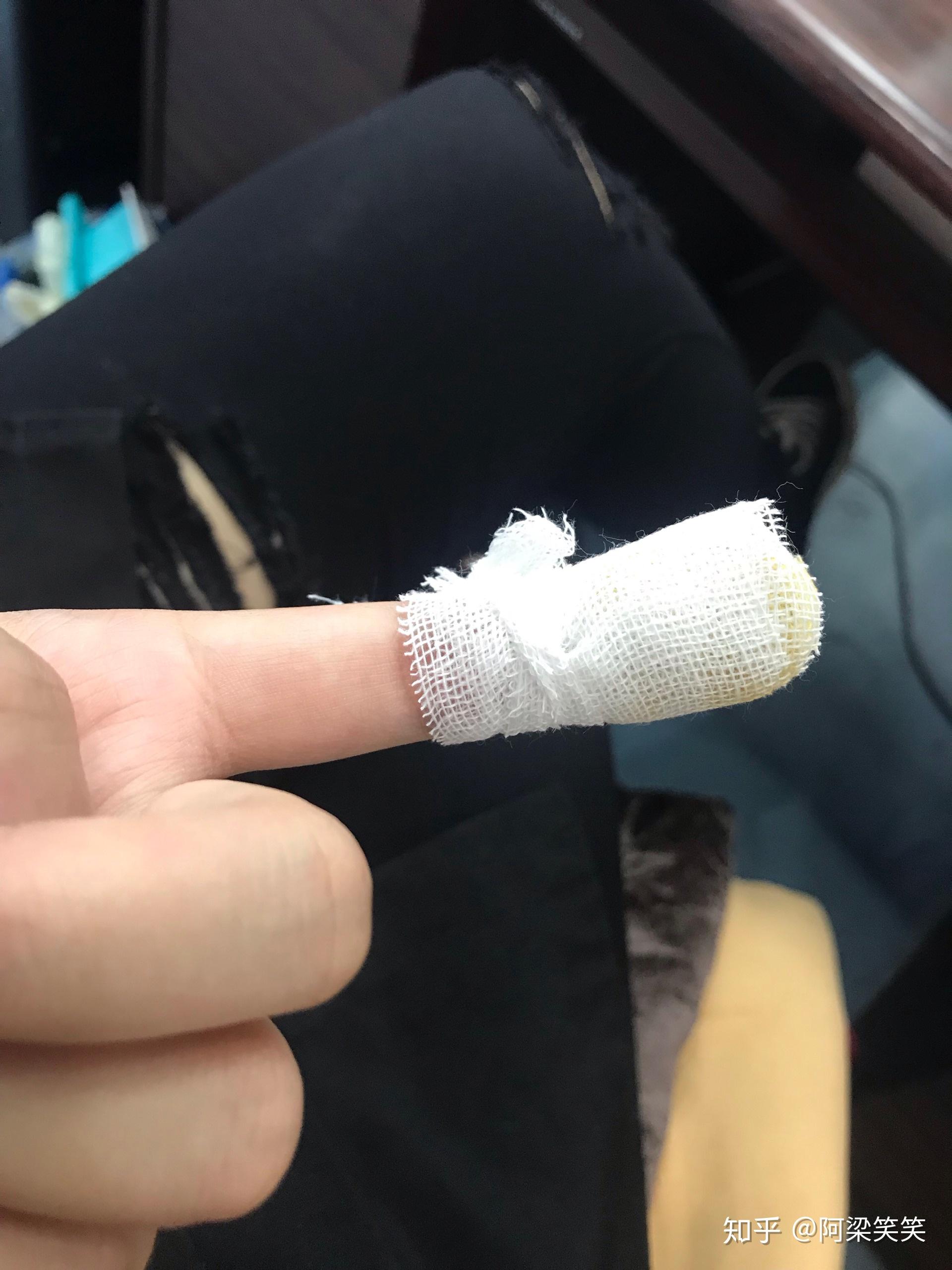 平时手指被割伤应该怎么处理