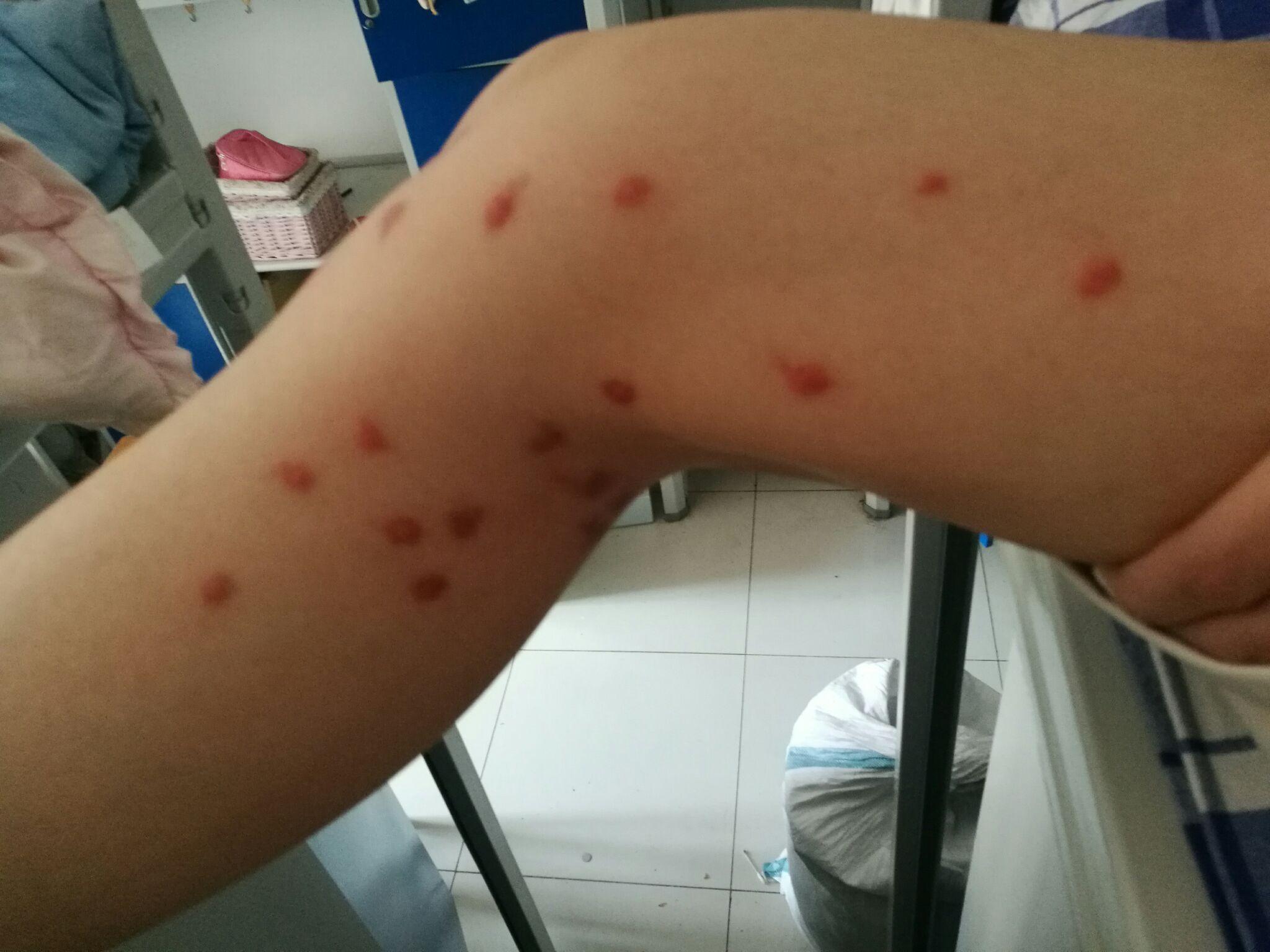 被跳蚤咬的全身都是包是什么样的感受! - 知乎