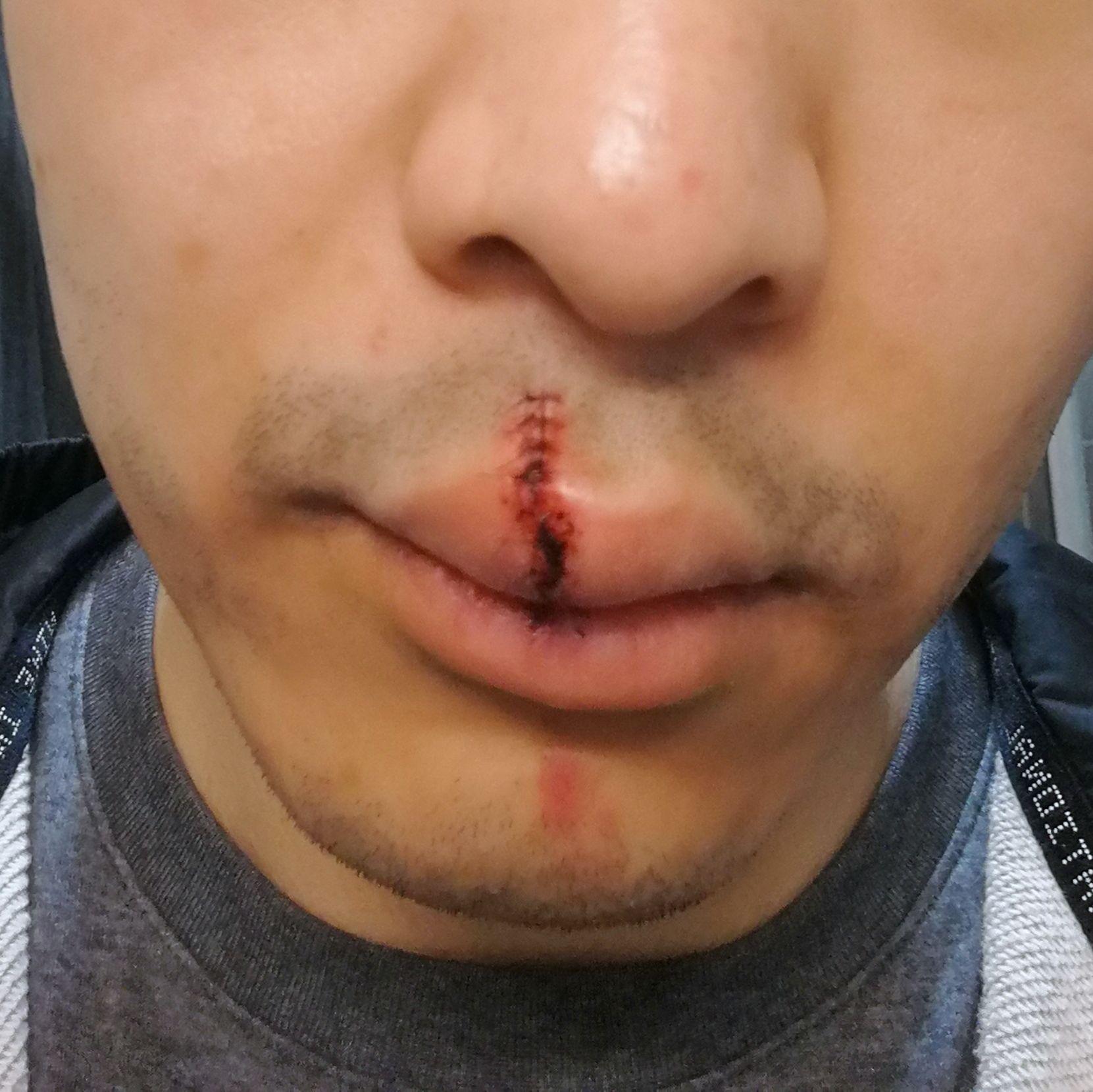 嘴唇缝针伤疤应该多久去医院修复? 