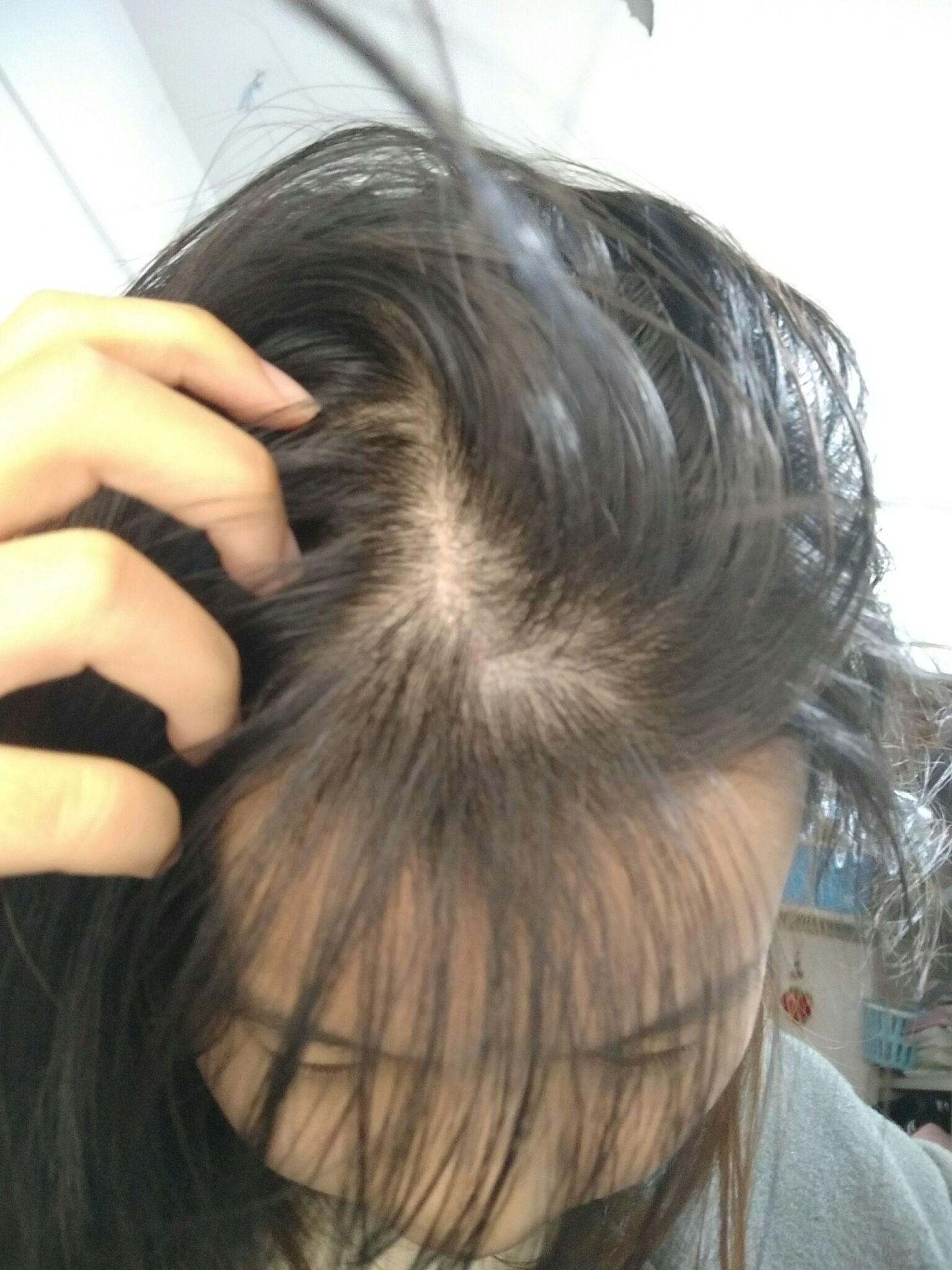 20岁女生脱发严重恐怖级别