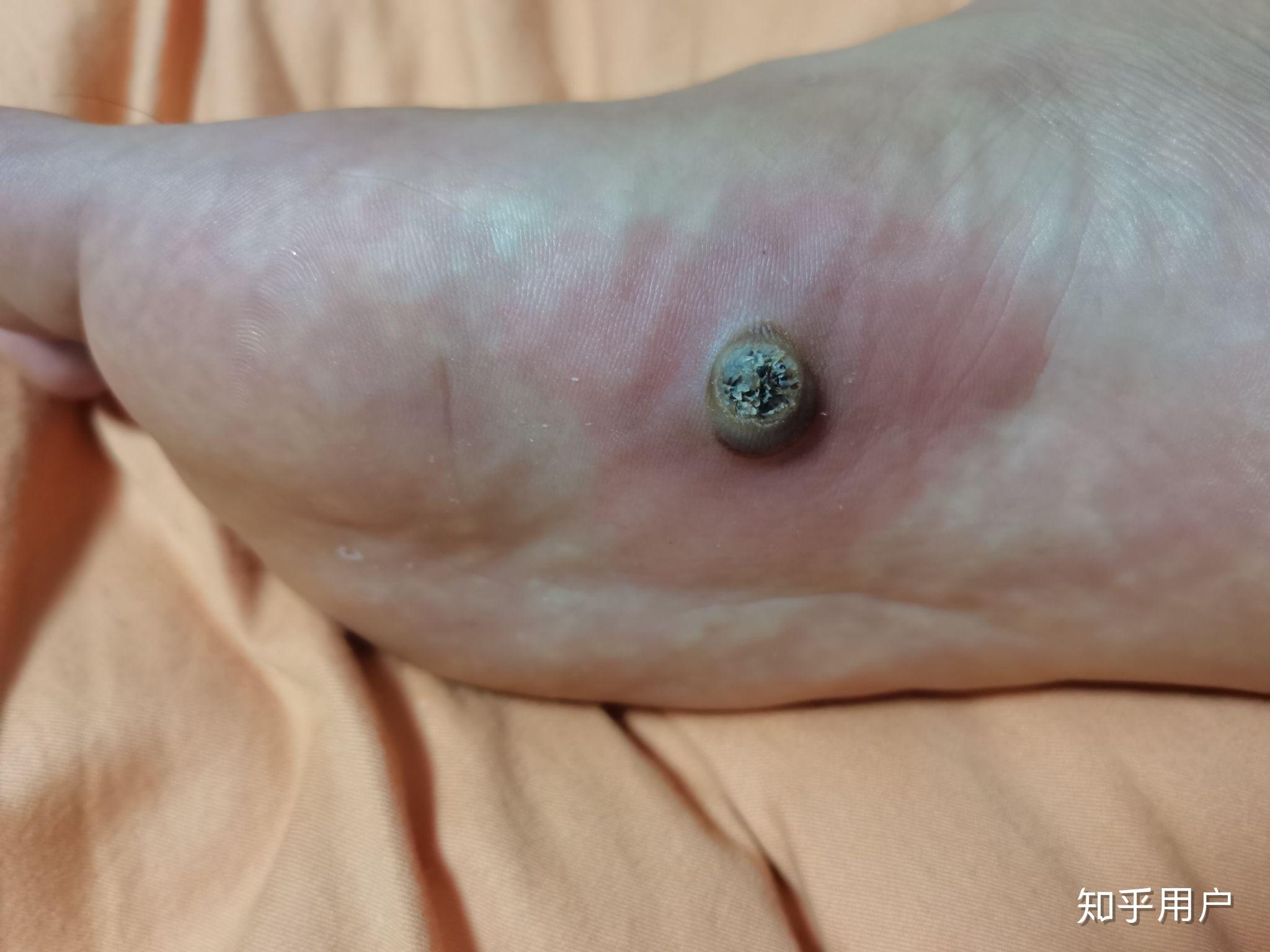 脚上长了跖疣怎么办? - 知乎