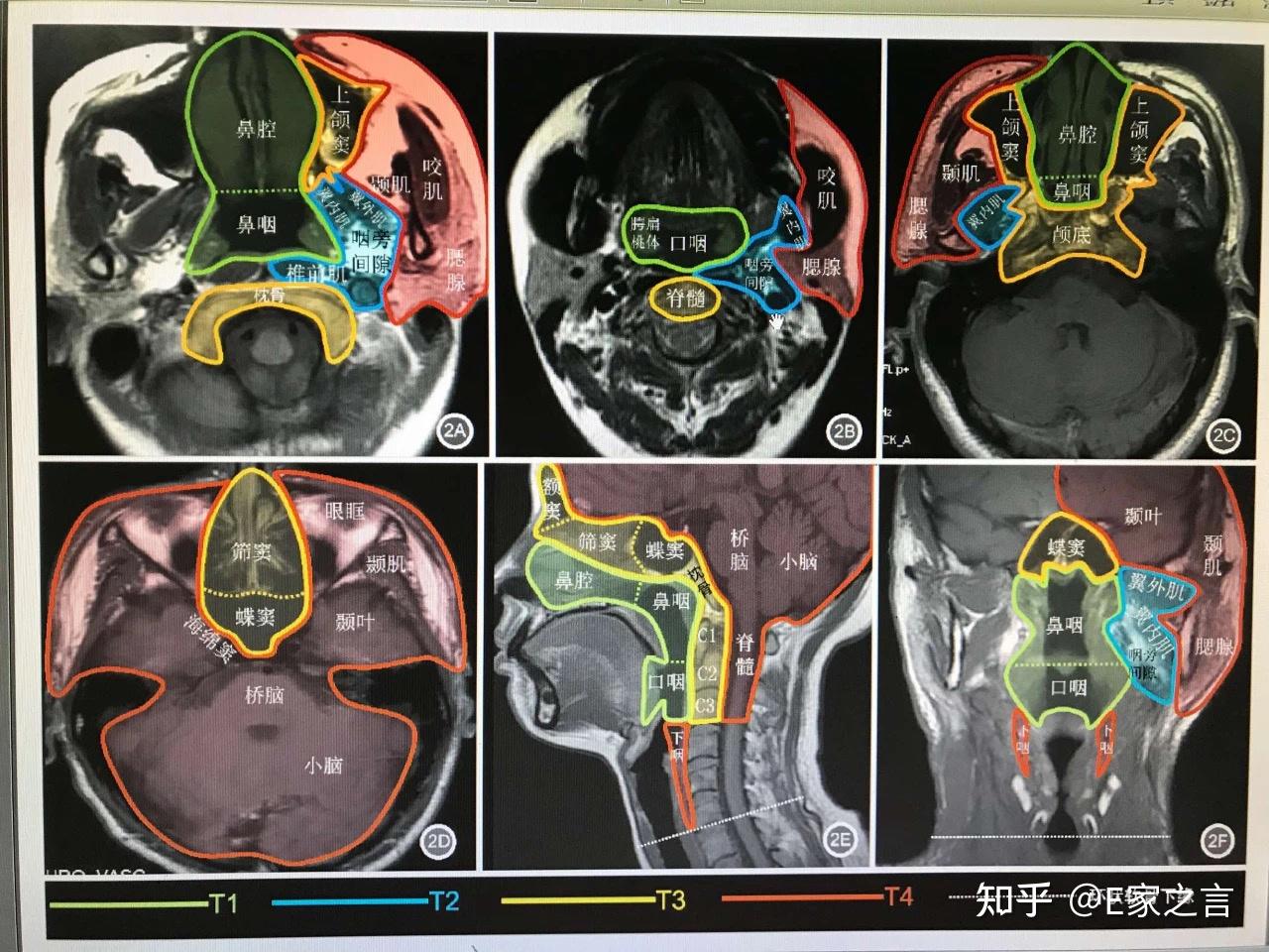 22岁男性上鼻窦疑似恶性肿瘤,但是做了全身ct没有转移,怎么判断早期