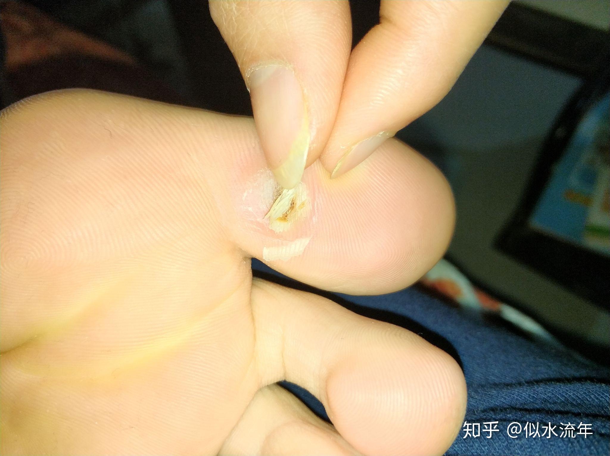 你是如何治好腳上長的雞眼的