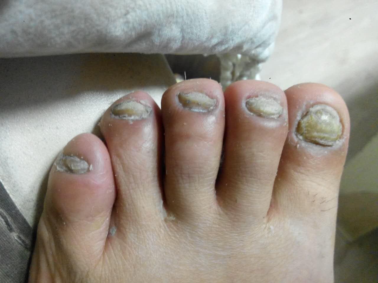 灰指甲治疗四十天了每天用大蒜醋泡脚每天用亮甲隔一天修指甲上药现在
