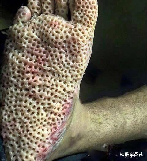 有强迫症和密集恐惧症是怎样的体验? - 知乎