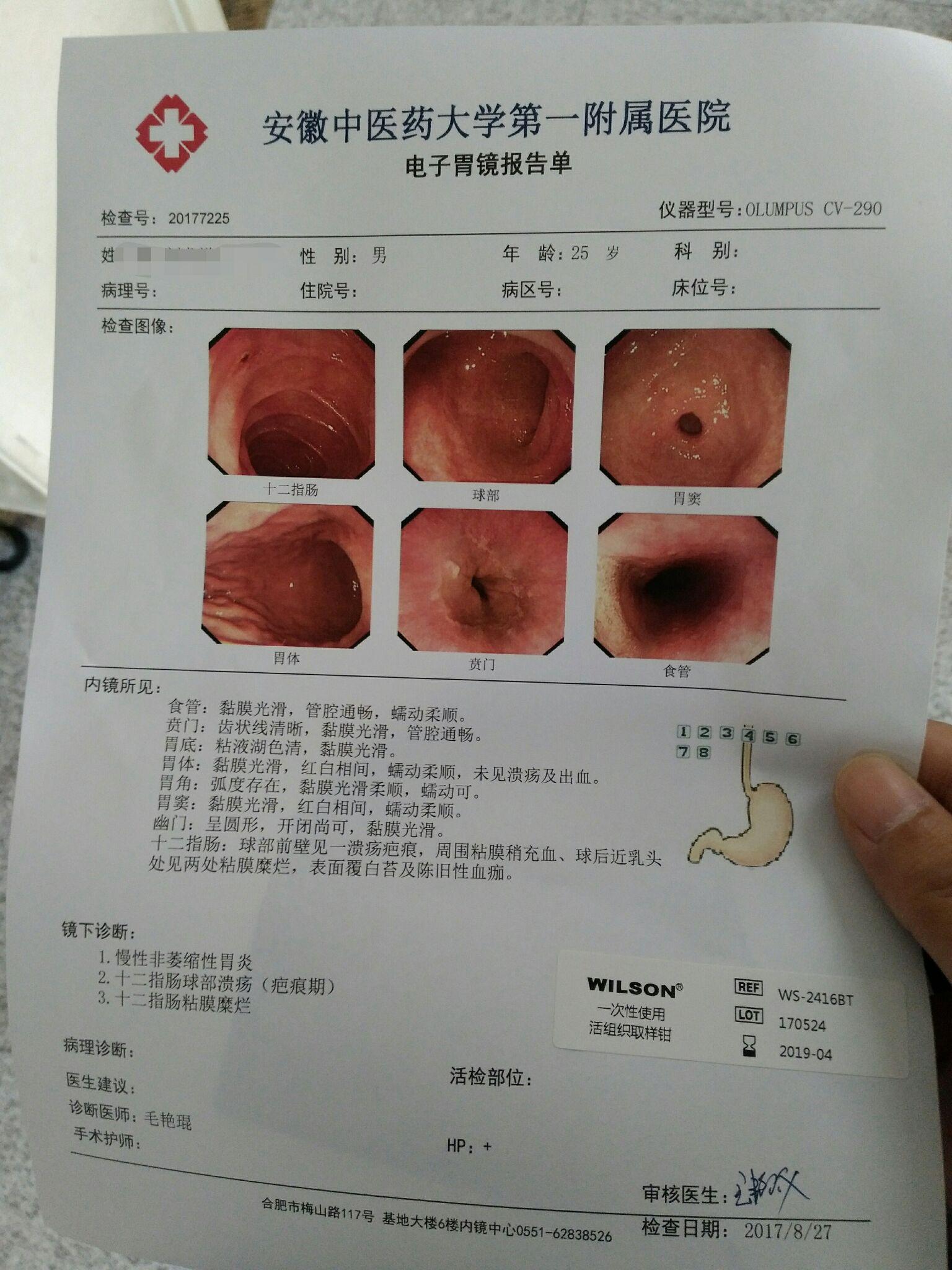 做胃镜是种怎样的体验