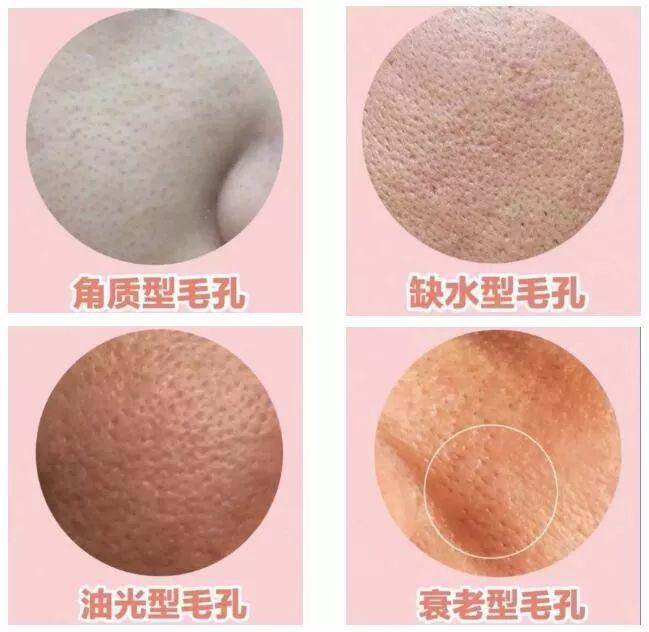 皮肤毛孔粗大的原因是什么?如何改善? - 知乎