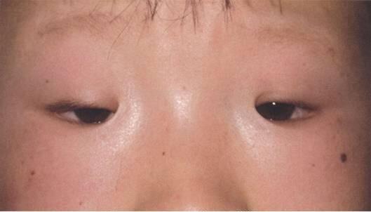 纠结要不要开眼角
