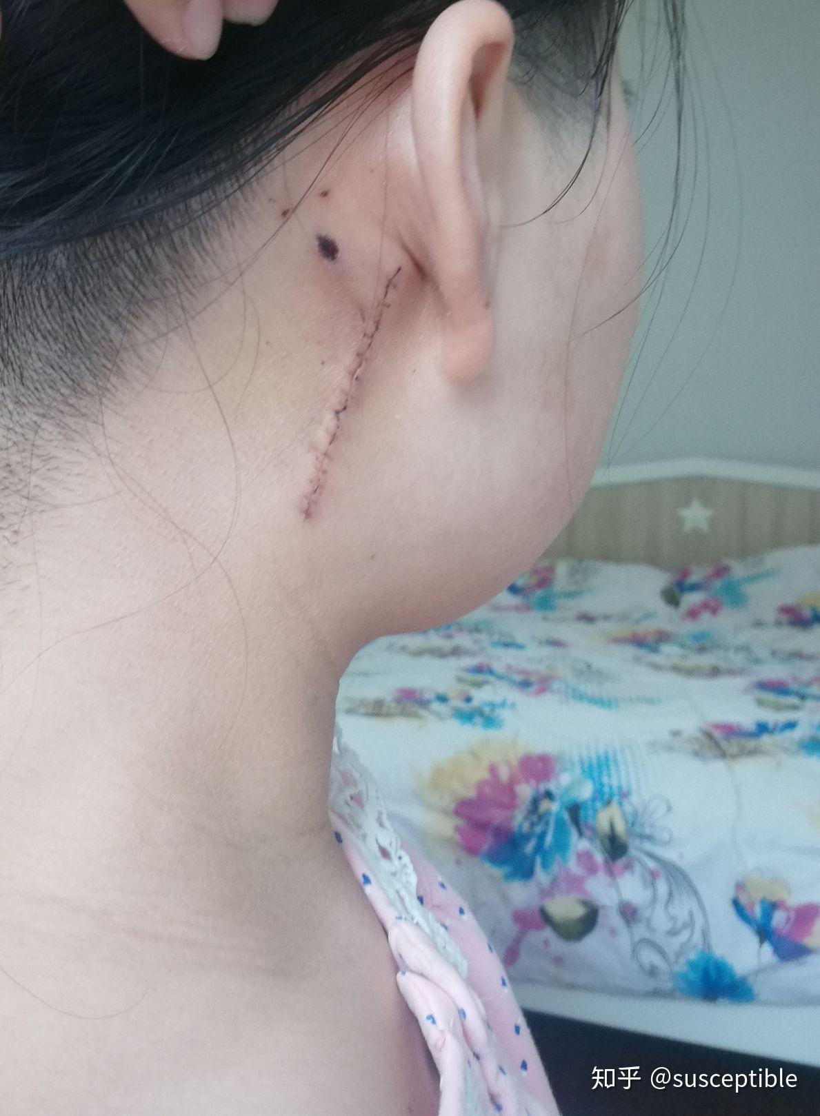 耳后颈部长了一个包块鼓起来了硬的跟骨头一样大概三cm左右