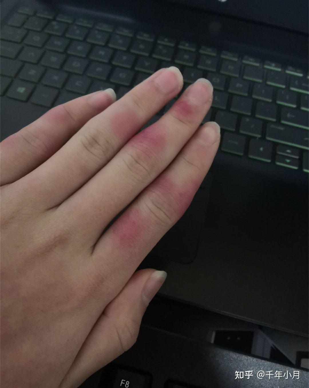 脚后跟长冻疮是一种怎样的体验