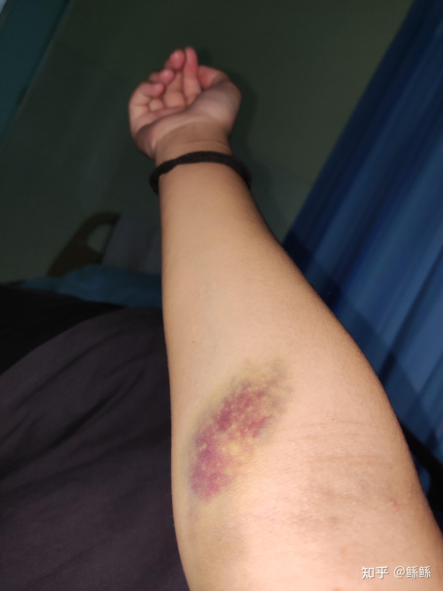 最近两次抽血都要左右各扎一针,完了还淤青一大片,心疼自己