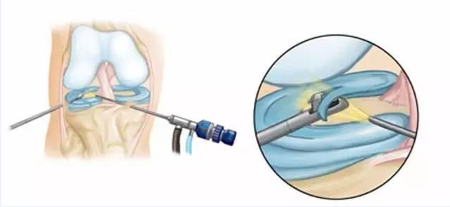 二度半月板损伤、三度半月板损伤，该如何治疗？ - 知乎