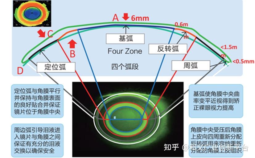 眼科高值耗材系列之假性近视矫正：硬性接触镜及OK镜介绍 - 知乎