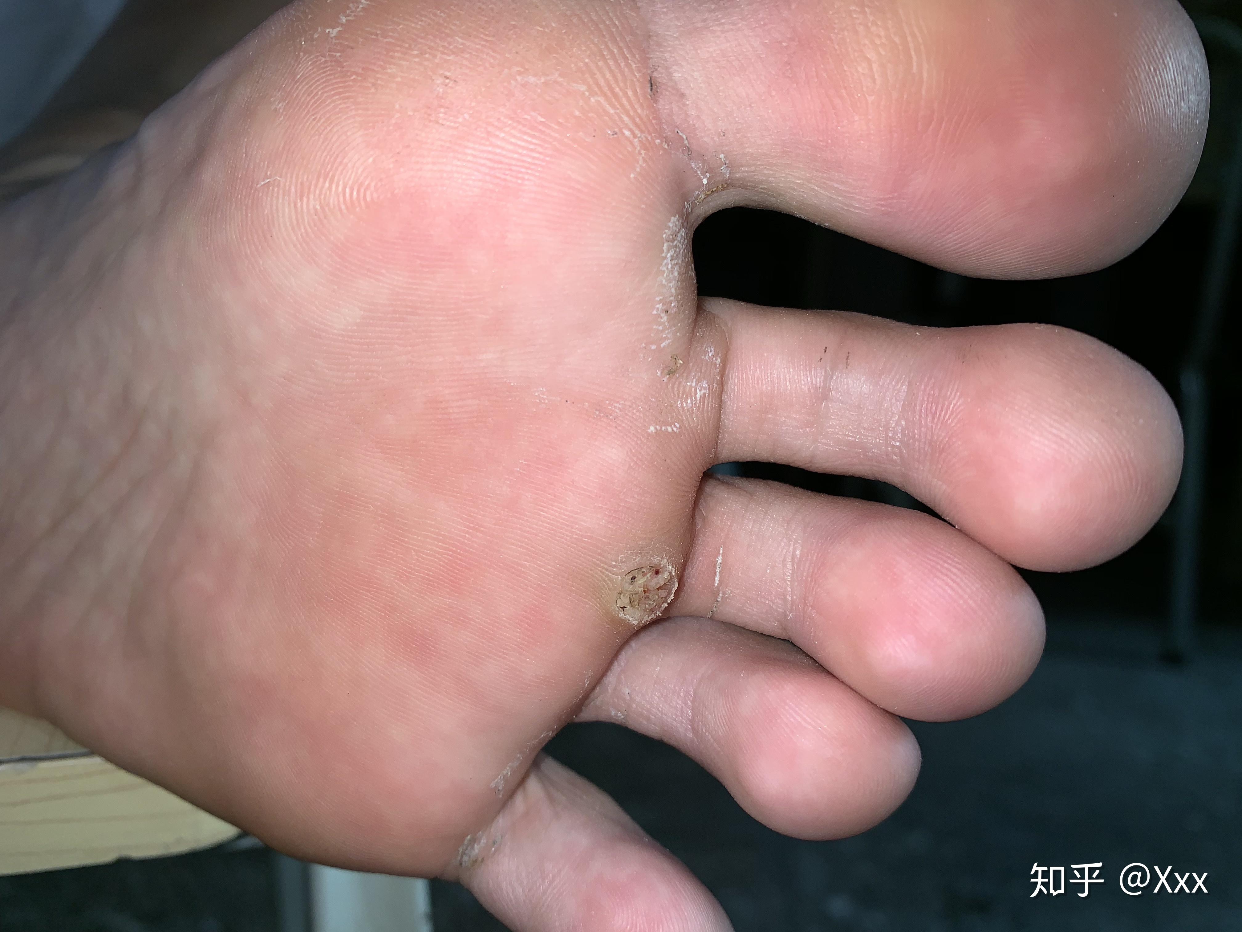 怎么分辨脚上长得是鸡眼还是疣?