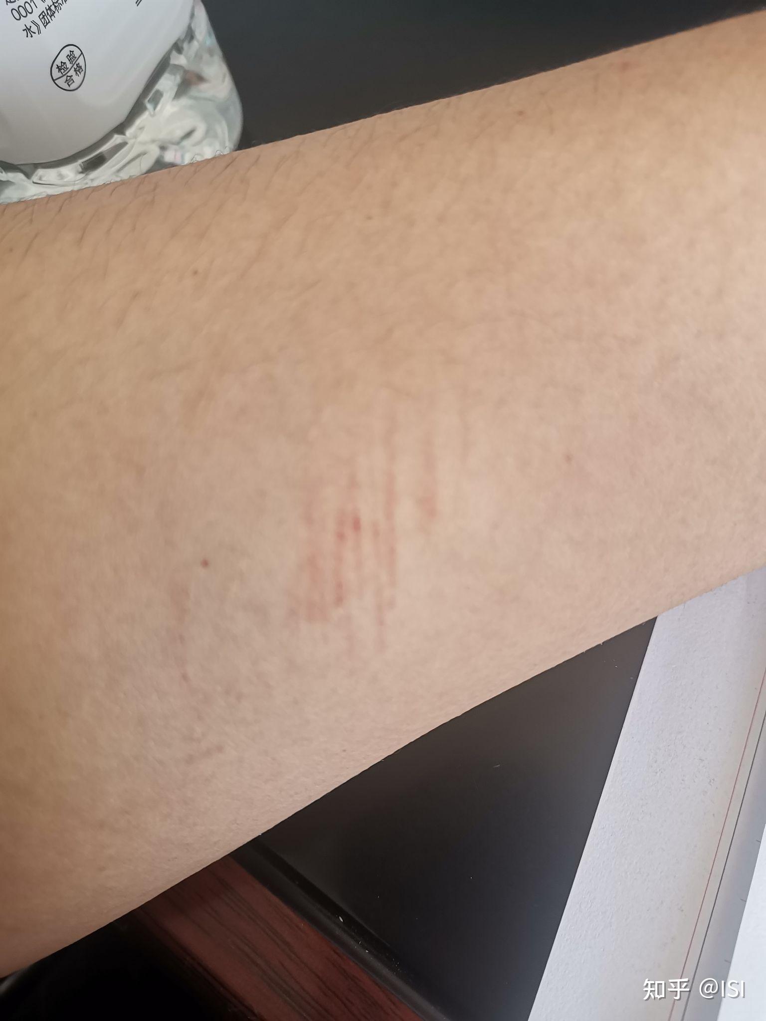 手臂莫名其妙出现伤痕是怎么回事? - 知乎