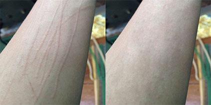 身上时不时会出现大面积的荨麻疹,该怎么办呢?