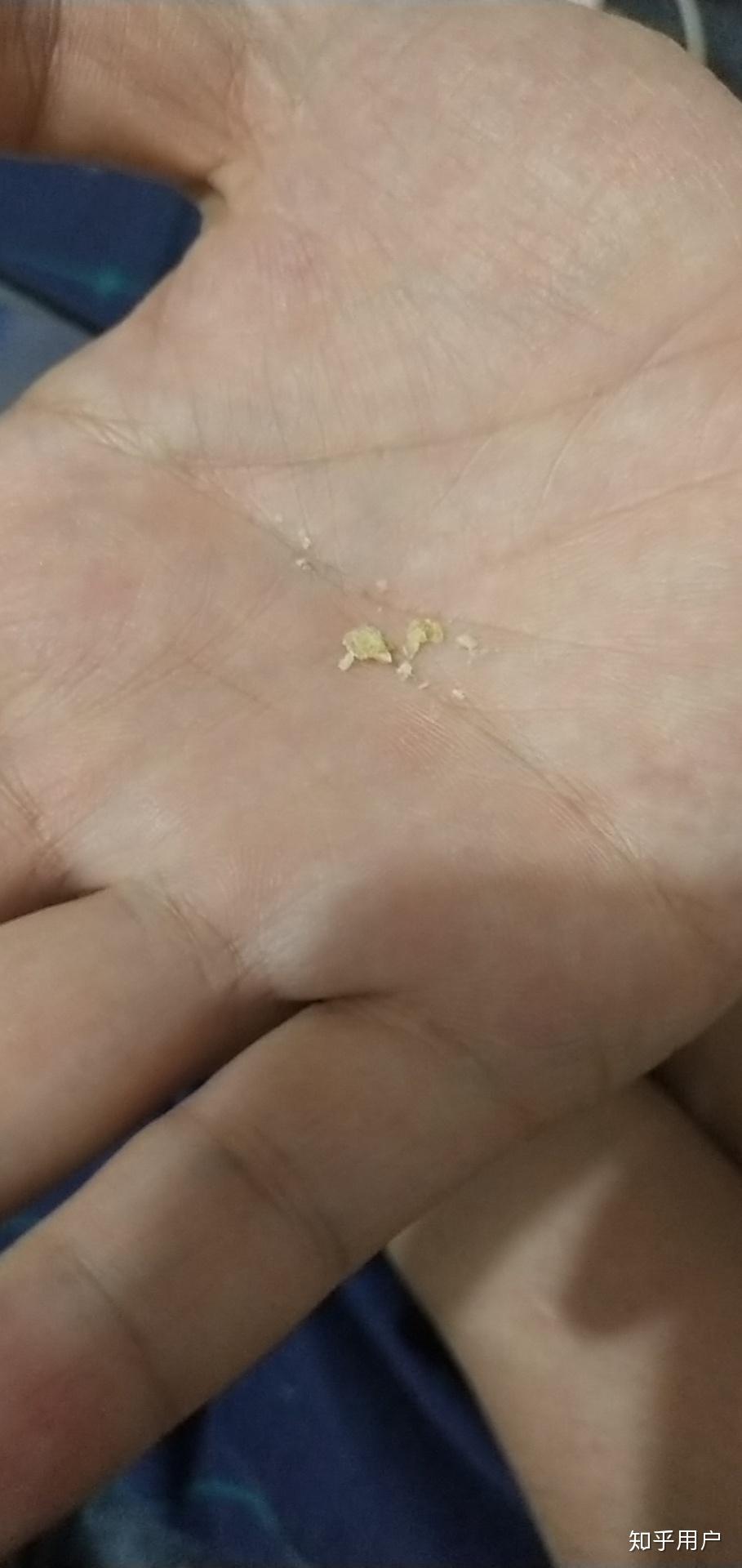 耳廓每天都会产生很多皮屑我该怎么办