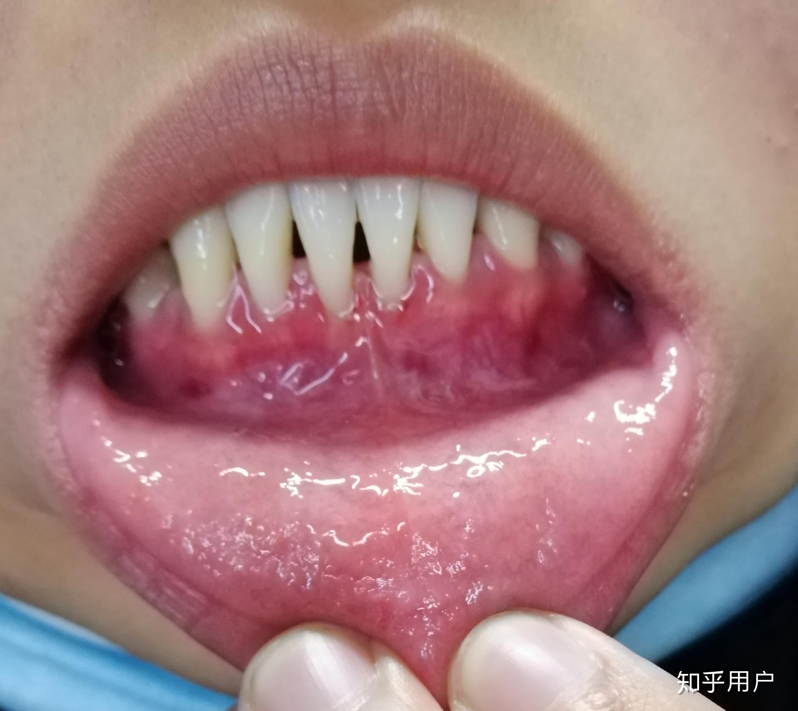 有人做过龈下刮治吗