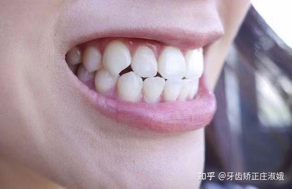 放松状态下上下牙齿是分开的还是咬在一起的