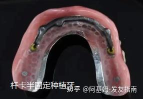 all-on-4和all-on-6有什么区别?全口种牙、半口种牙价格咋样?医生有推荐吗? - 知乎