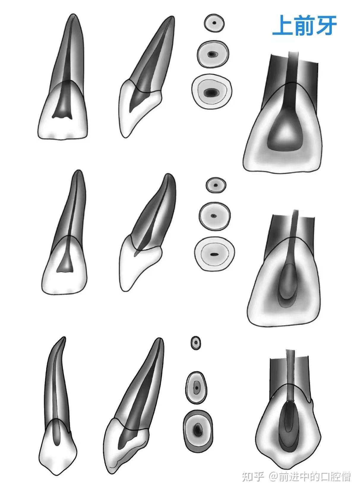 根管治疗图解:6种开髓位置及洞型