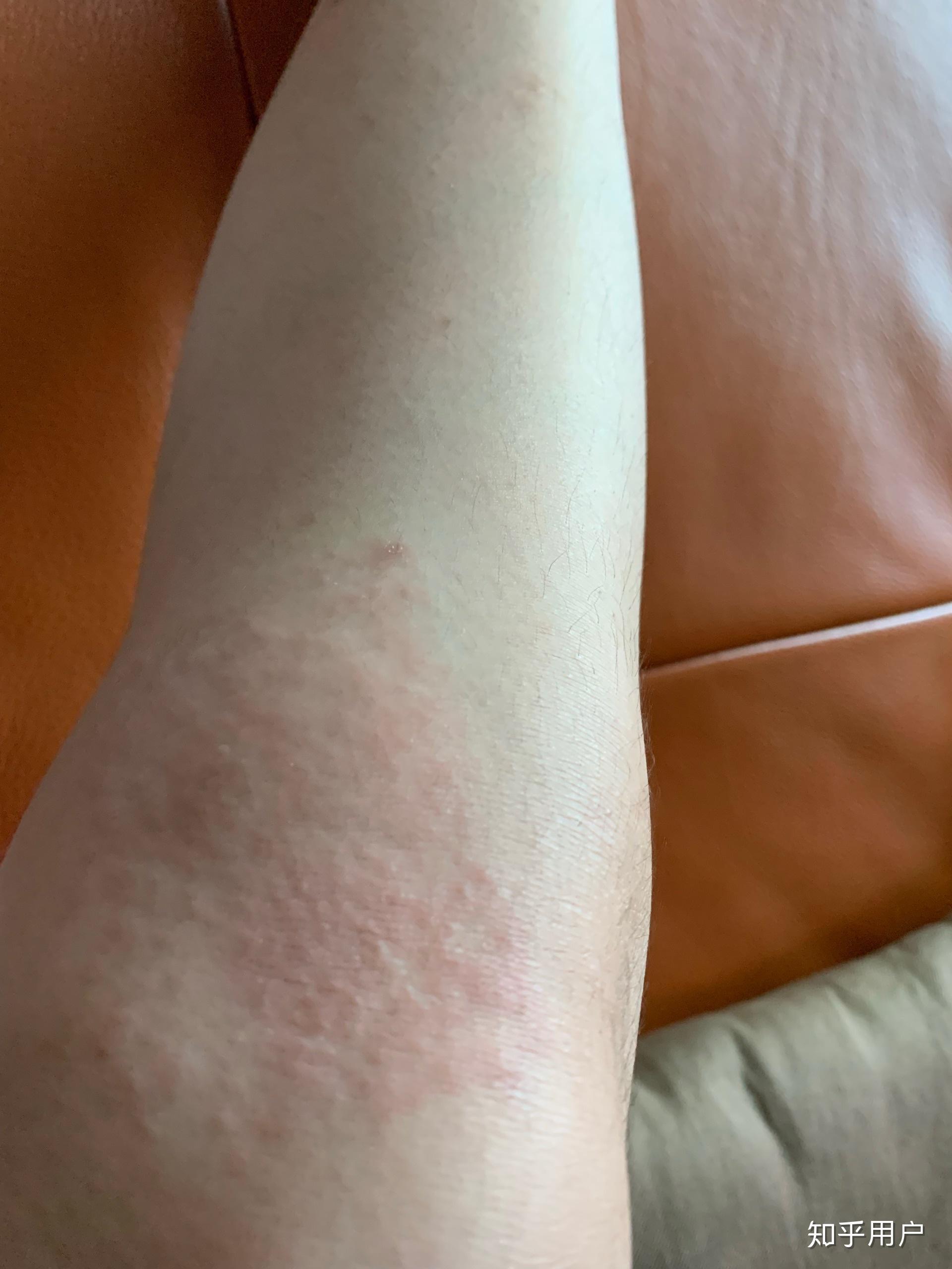 贴膏药过敏怎么办