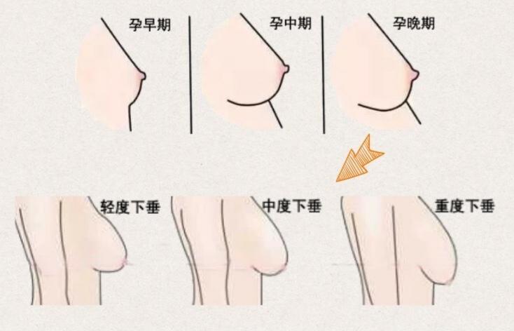 哺乳期后胸部一定会缩水吗有什么方法可以补救不用母乳喂养宝宝是否