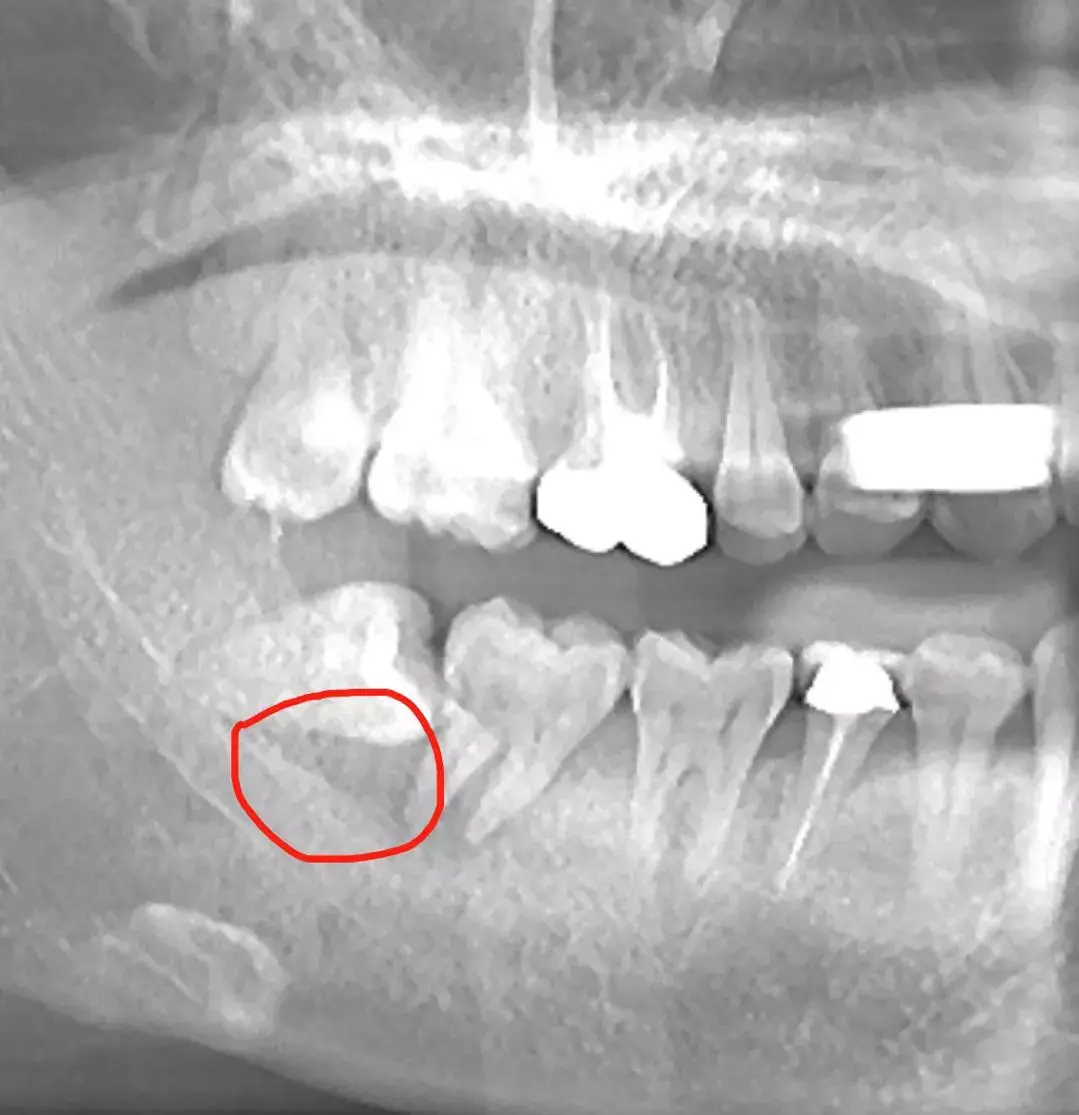 关注问题 67 写回答 登录/注册 智齿 牙齿 拔牙 拔了四颗智齿的人